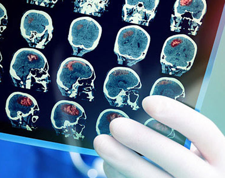 egkefaliko